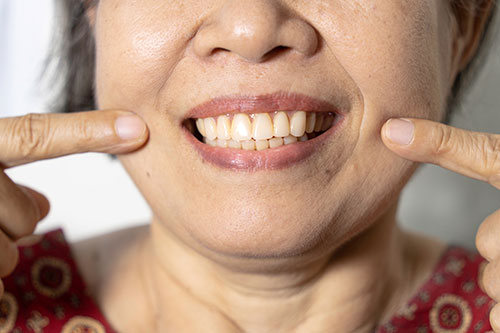 Close-up image of a smiling woman wearing dentures