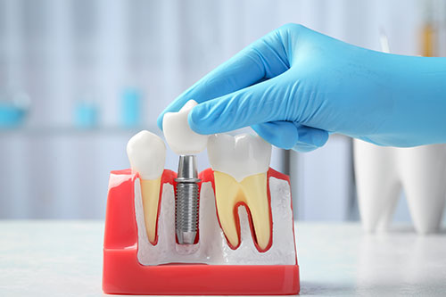 A 3D model of a dental implant