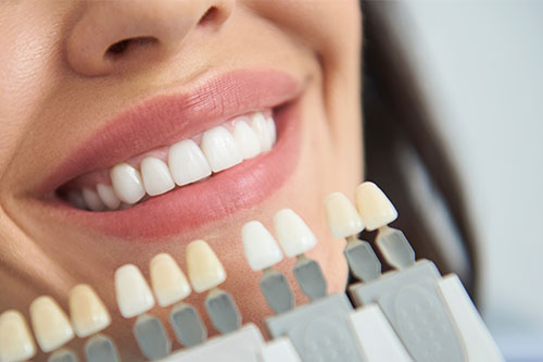 Close-up of a smile displaying teeth shade chart for colour comparison