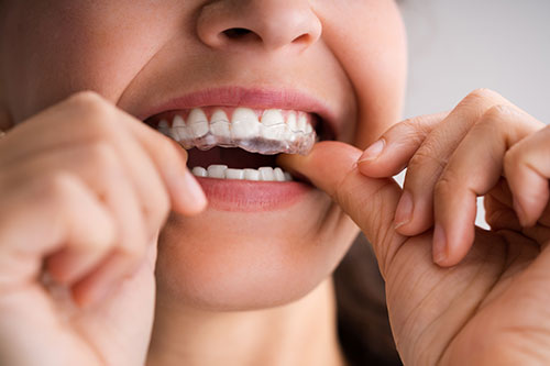 Close-up of a woman using her clear aligners